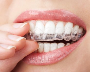 Lentes de Contato Dental: Vantagens e Desvantagens